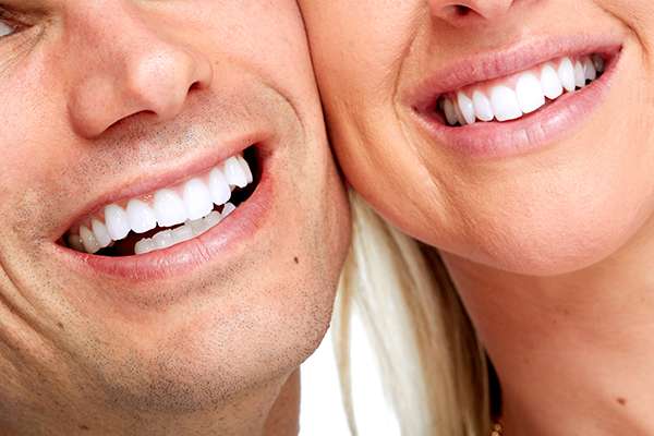 Dental Veneers